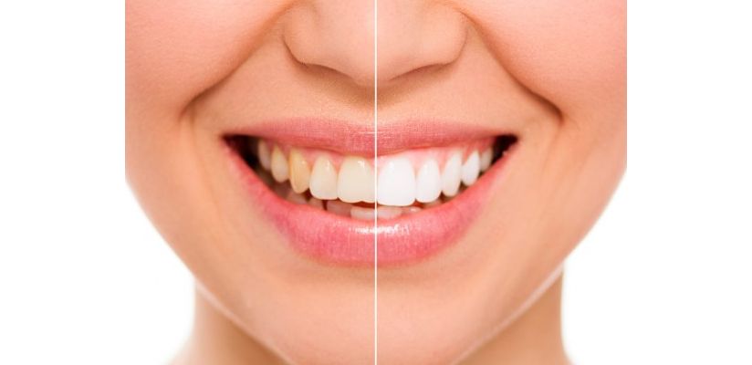 Veilig uw tanden bleken met Zoom vanaf oktober bij tandartspraktijken Mondmedicentrum Tiel en